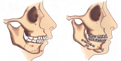 双颚手术动画图