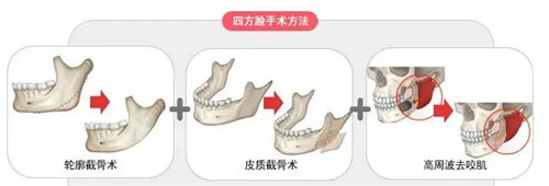 下颌角长曲线截骨和劈外板有什么区别？手术方法价格不同