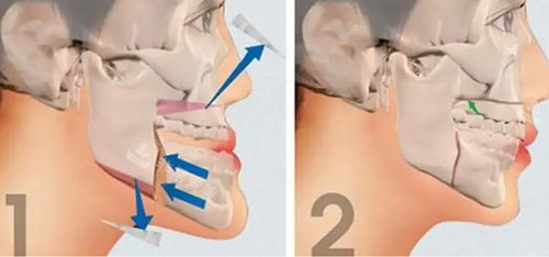 韩国双颚手术和国内一样吗？faceline是韩国双颚经验多的医院
