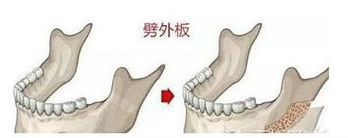 劈外板图