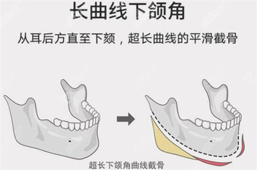 长曲线下颌角图