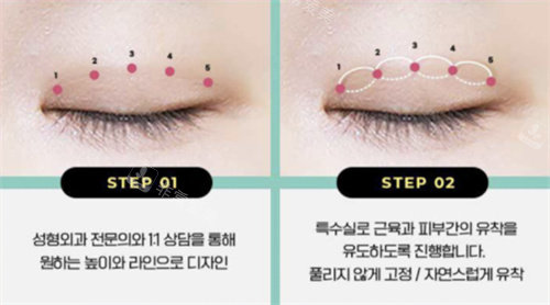 韩国POP整形外科缝合方式展示图