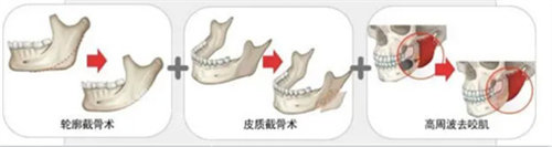 輪廓手術方法圖