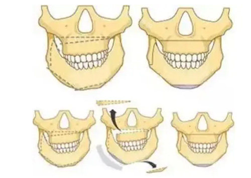 正颌手术演示图