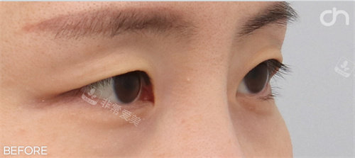 埋線雙眼皮前照片 埋線雙眼皮前照片