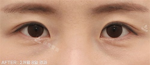 埋線雙眼皮后照片 埋線雙眼皮后照片