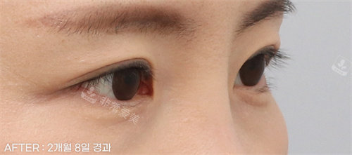 埋線雙眼皮后照片 埋線雙眼皮后照片