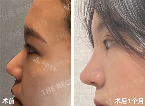 韓國(guó)JN整形外科鼻整形前后圖 韓國(guó)JN整形外科鼻整形前后圖