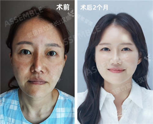 韩国德丽珍整形外科拉皮手术对比照