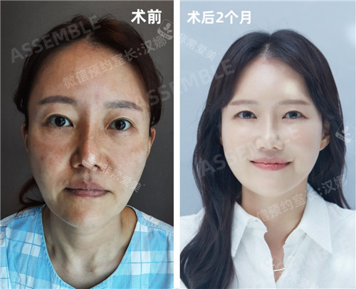 韓國(guó)JN整形外科拉皮手術(shù)對(duì)比照 韓國(guó)JN整形外科拉皮手術(shù)對(duì)比照
