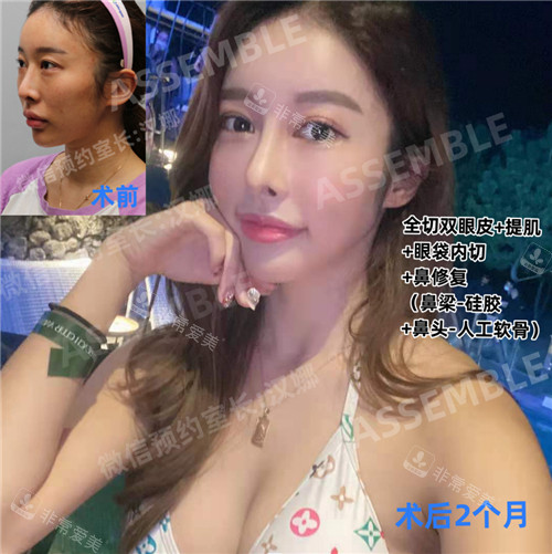 韓國(guó)JN整形外科眼鼻整形對(duì)比照 韓國(guó)JN整形外科眼鼻整形對(duì)比照