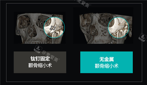 無金屬顴骨縮小術展示 無金屬顴骨縮小術展示