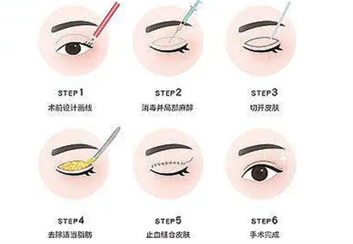 雙眼皮流程圖 雙眼皮流程圖
