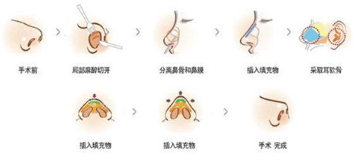 隆鼻手术过程图