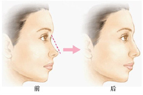 隆鼻前后對比圖