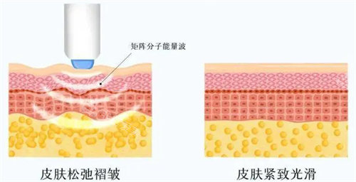 热玛吉工作原理展示图