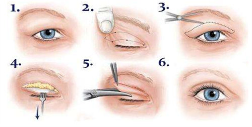 双眼皮手术流程图