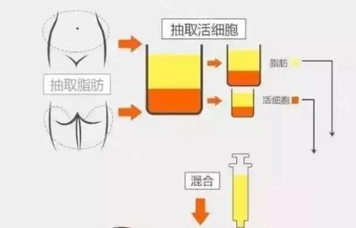 脂肪填充過(guò)程圖 脂肪填充過(guò)程圖