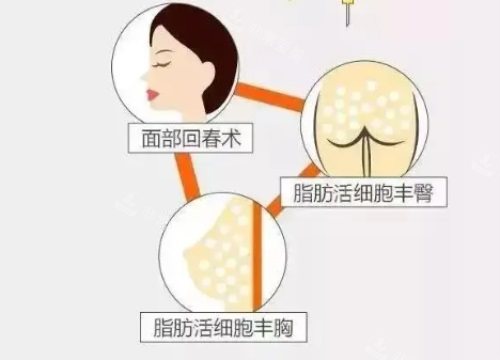 脂肪填充作用 脂肪填充作用