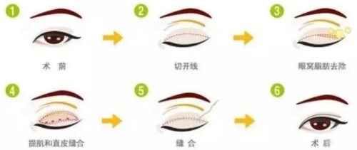 雙眼皮手術(shù)示意圖 雙眼皮手術(shù)示意圖