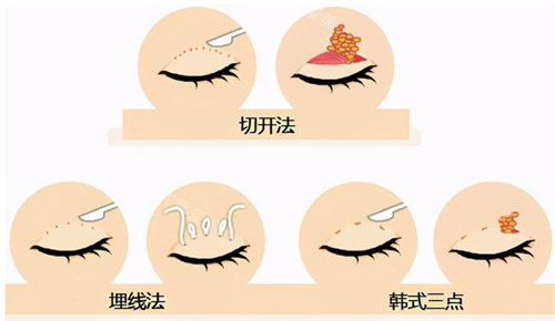 雙眼皮手術(shù)圖 雙眼皮手術(shù)圖