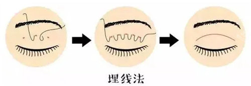 埋線雙眼皮 埋線雙眼皮
