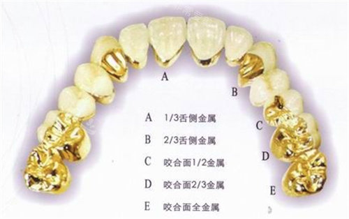 烤瓷牙材質(zhì)圖