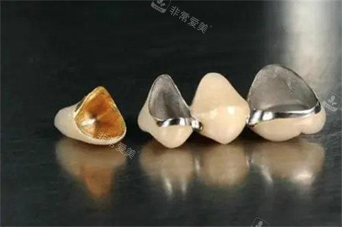 烤瓷牙圖