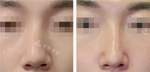 韩国绮林整形鼻子整形前后照片