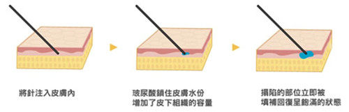填充皮膚變化圖 填充皮膚變化圖