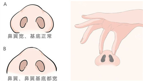 鼻尖鼻翼整形動畫圖