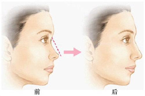 鼻修復(fù)手術(shù)前后對比圖 鼻修復(fù)手術(shù)前后對比圖