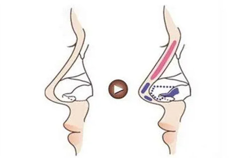 隆鼻支架结构展示图