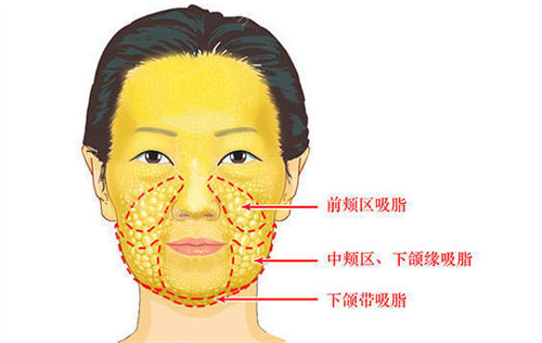 中面部脂肪分布展示圖