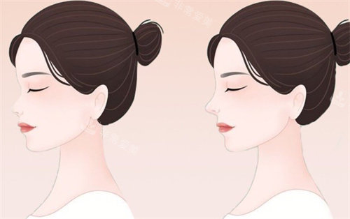 肋骨隆鼻動畫對比圖