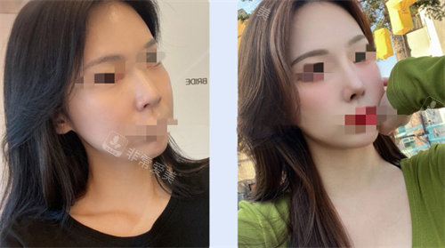 韩国玛博尔整形医院隆鼻展示图