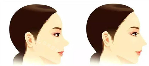 韩国玛博尔整形鼻子案例，术后惊艳徐逸范做鼻子很出名！