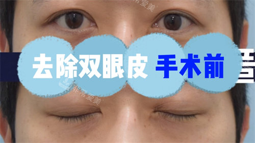 去除雙眼皮手術(shù)前圖片 去除雙眼皮手術(shù)前圖片