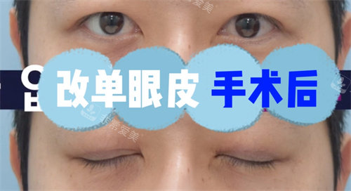 改單眼皮手術(shù)后圖片 改單眼皮手術(shù)后圖片