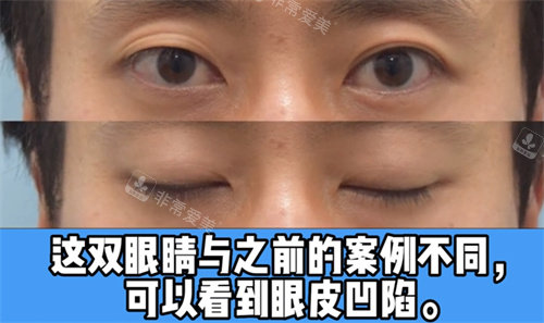 眼皮有凹陷情況 眼皮有凹陷情況
