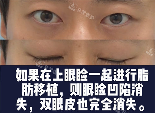 上瞼脂肪移植手術(shù) 上瞼脂肪移植手術(shù)
