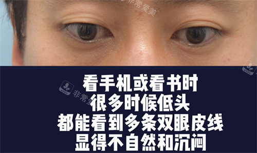 術(shù)前低頭眼睛的狀態(tài) 術(shù)前低頭眼睛的狀態(tài)