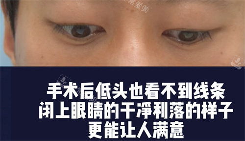 術(shù)后低頭眼睛的狀態(tài) 術(shù)后低頭眼睛的狀態(tài)