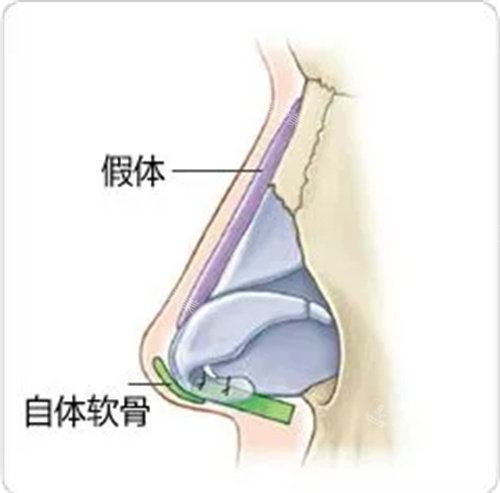 隆鼻假体图