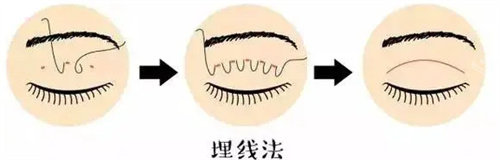埋線雙眼皮圖