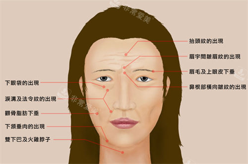 面部衰老部位展示图 面部衰老部位展示图