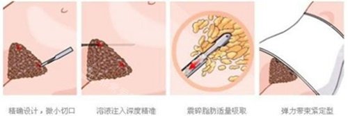 腹部吸脂示意圖