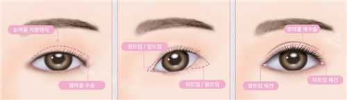 韩国绮林整形眼部手术步骤图
