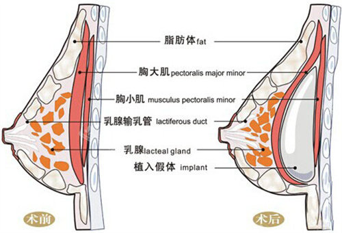 假体隆胸前后图