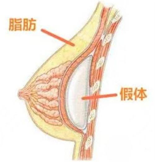 假体隆胸展示图